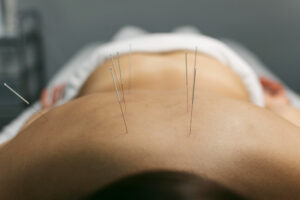 acupuncture | hara-foundation